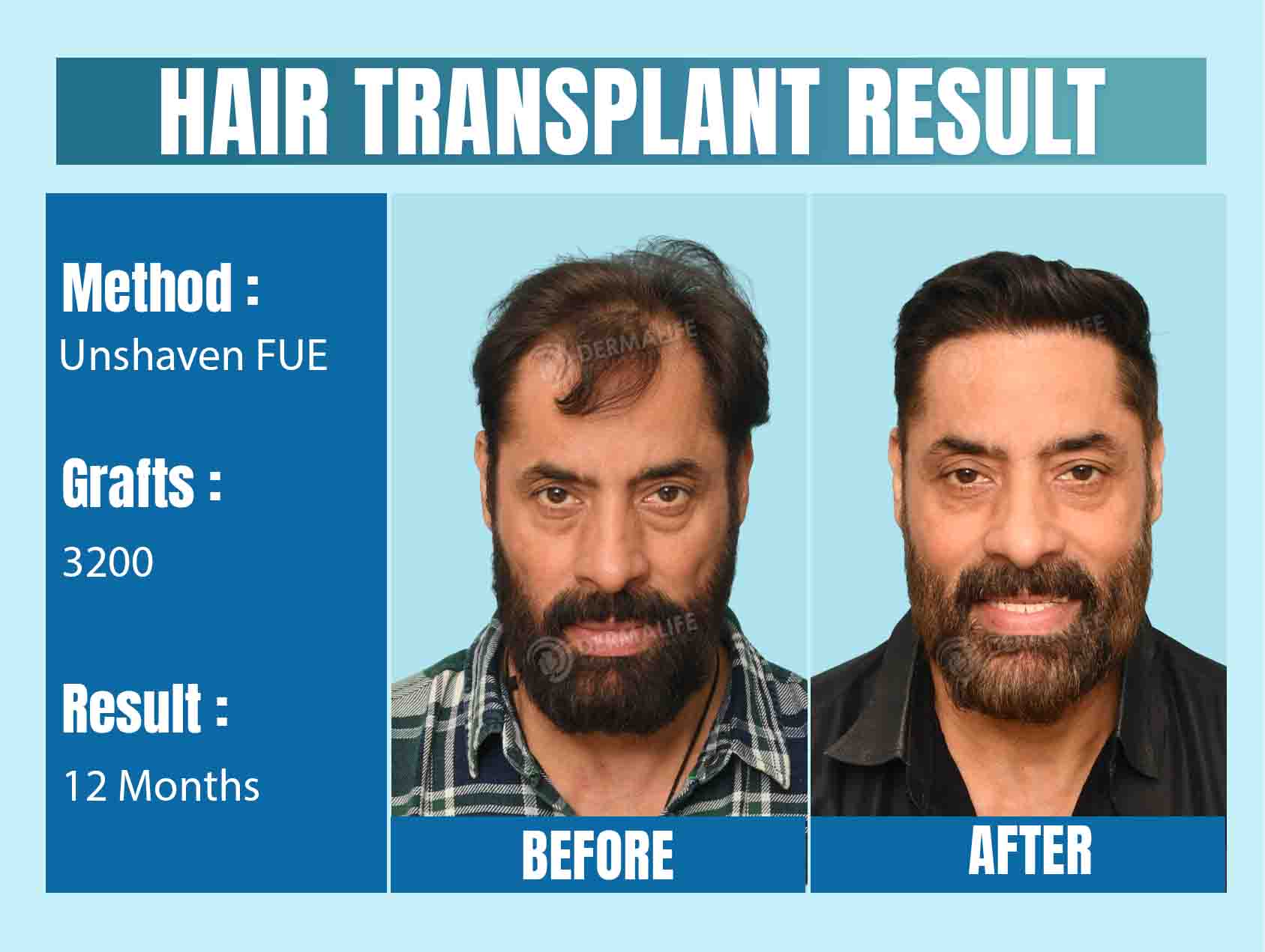 hair transplant