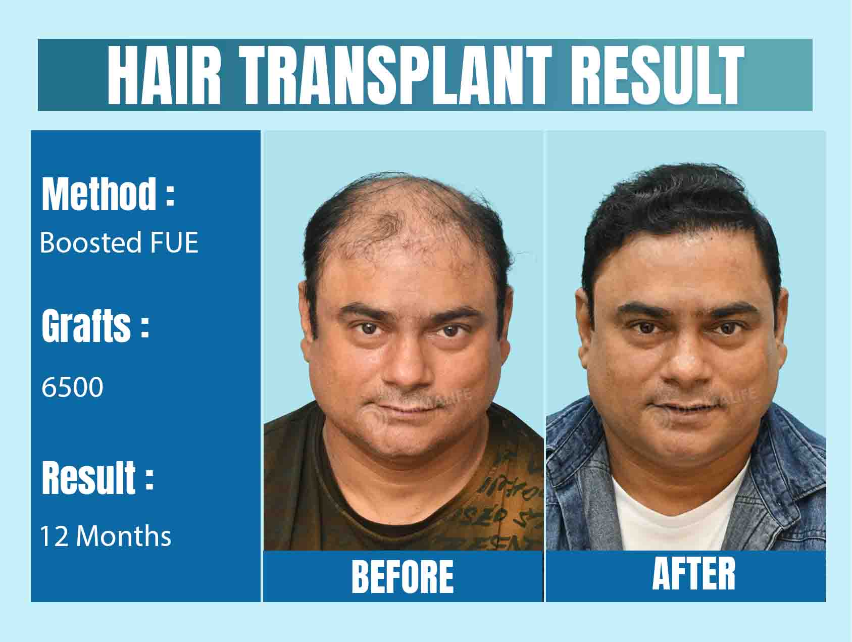 hair transplant